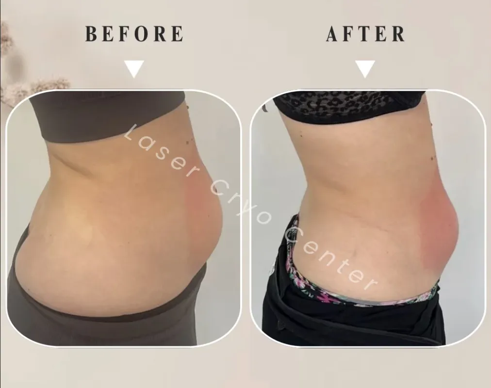 Résultat cryolipolyse avant et après - 2