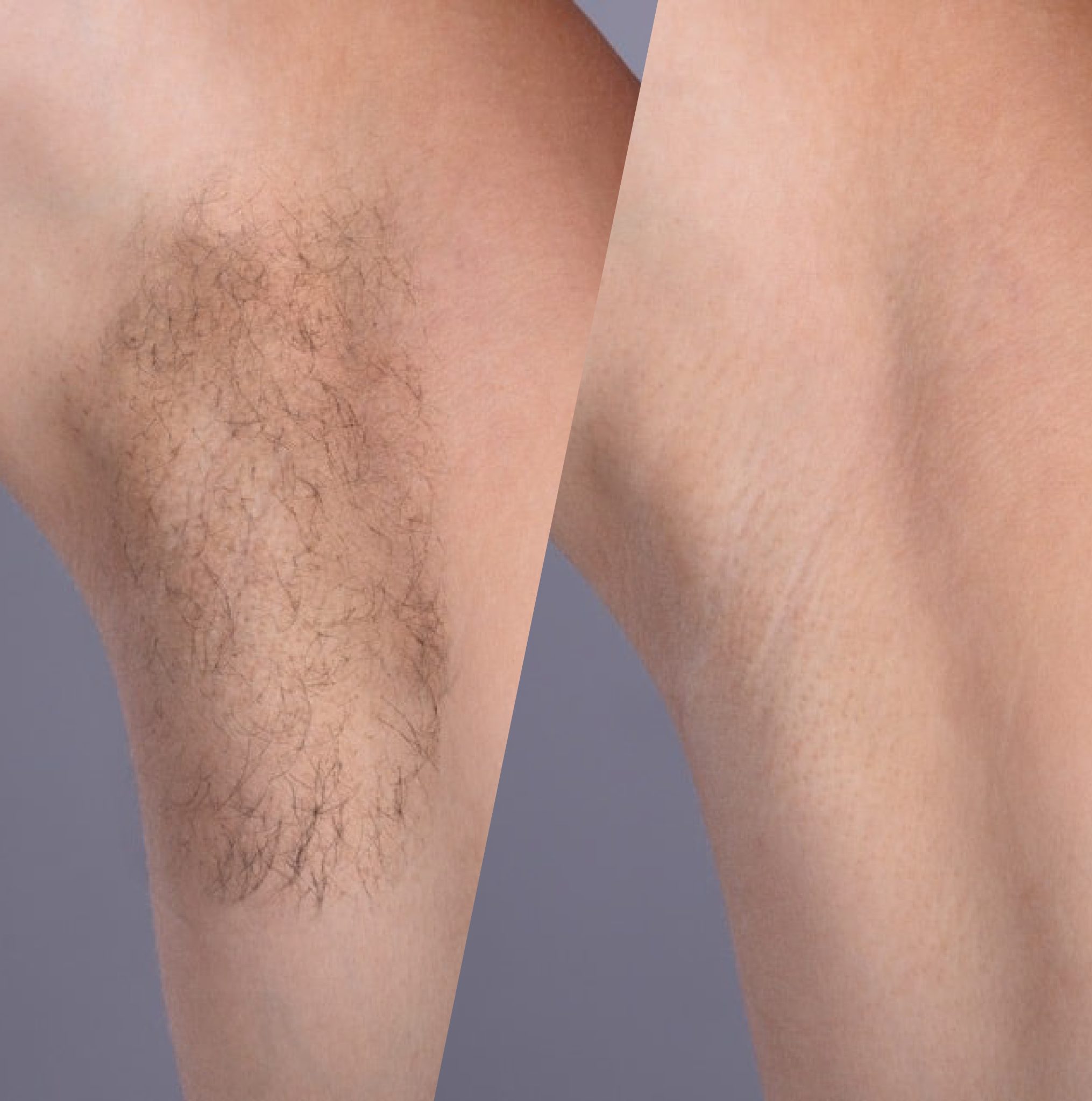 Résultat épilation laser avant et après - 1