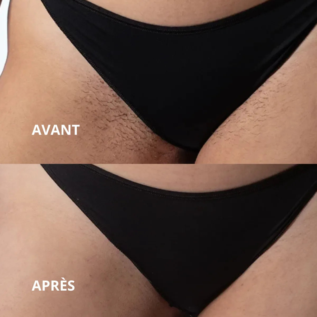 Résultat épilation laser avant et après - 2